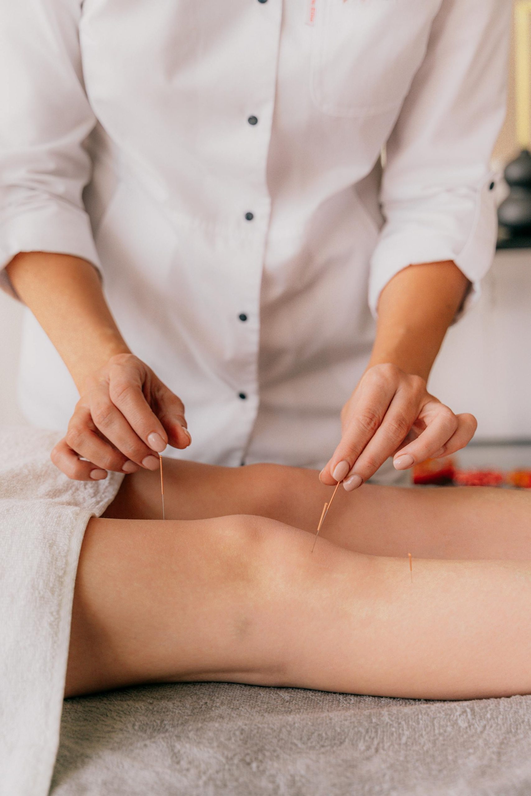 Acupuncturist inserting needles into a patient’s leg during a professional session, illustrating the precision of both acupuncture and SEO strategies.