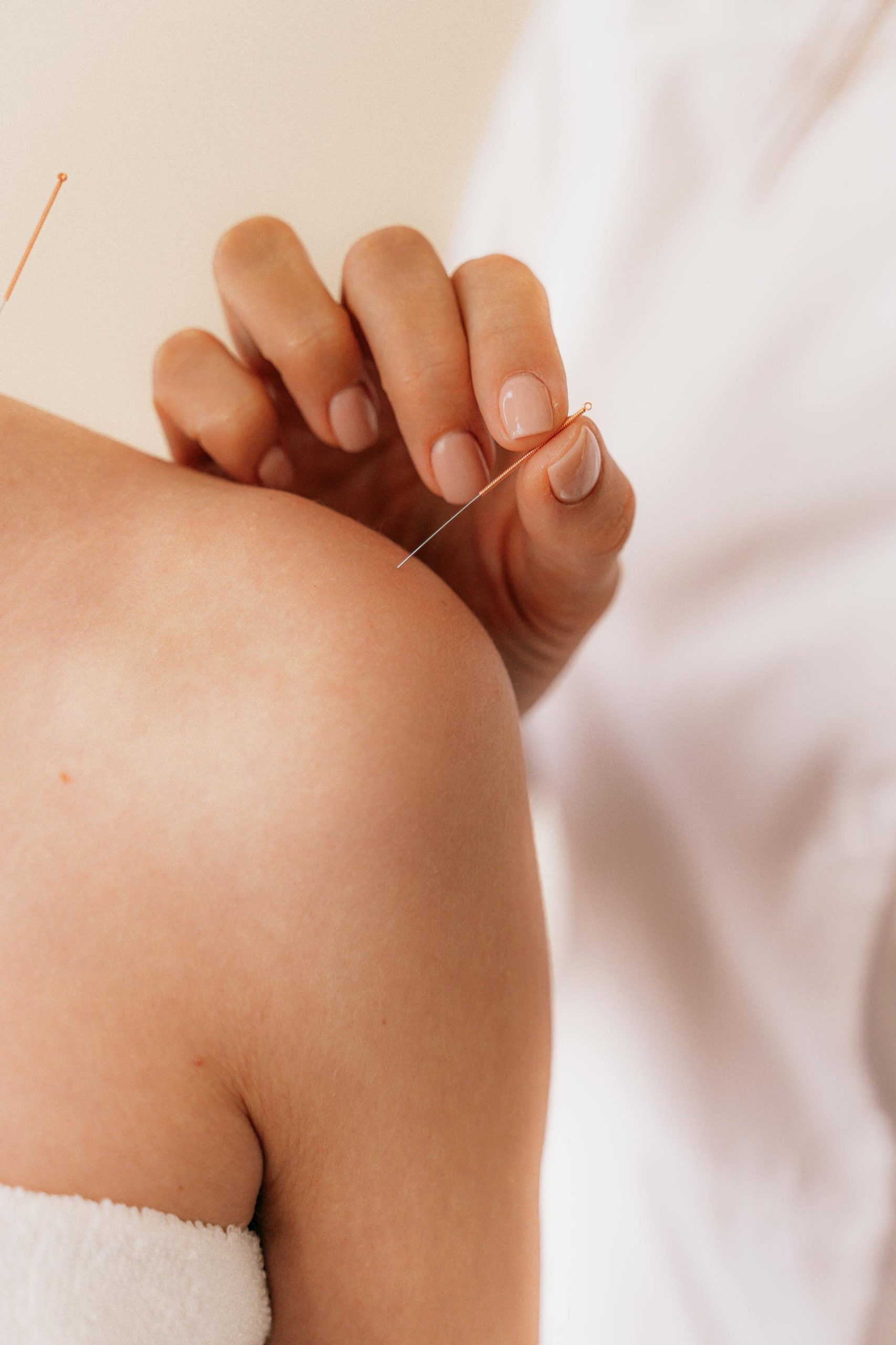 Acupuncturist inserting a needle into a patient’s shoulder during a traditional acupuncture session