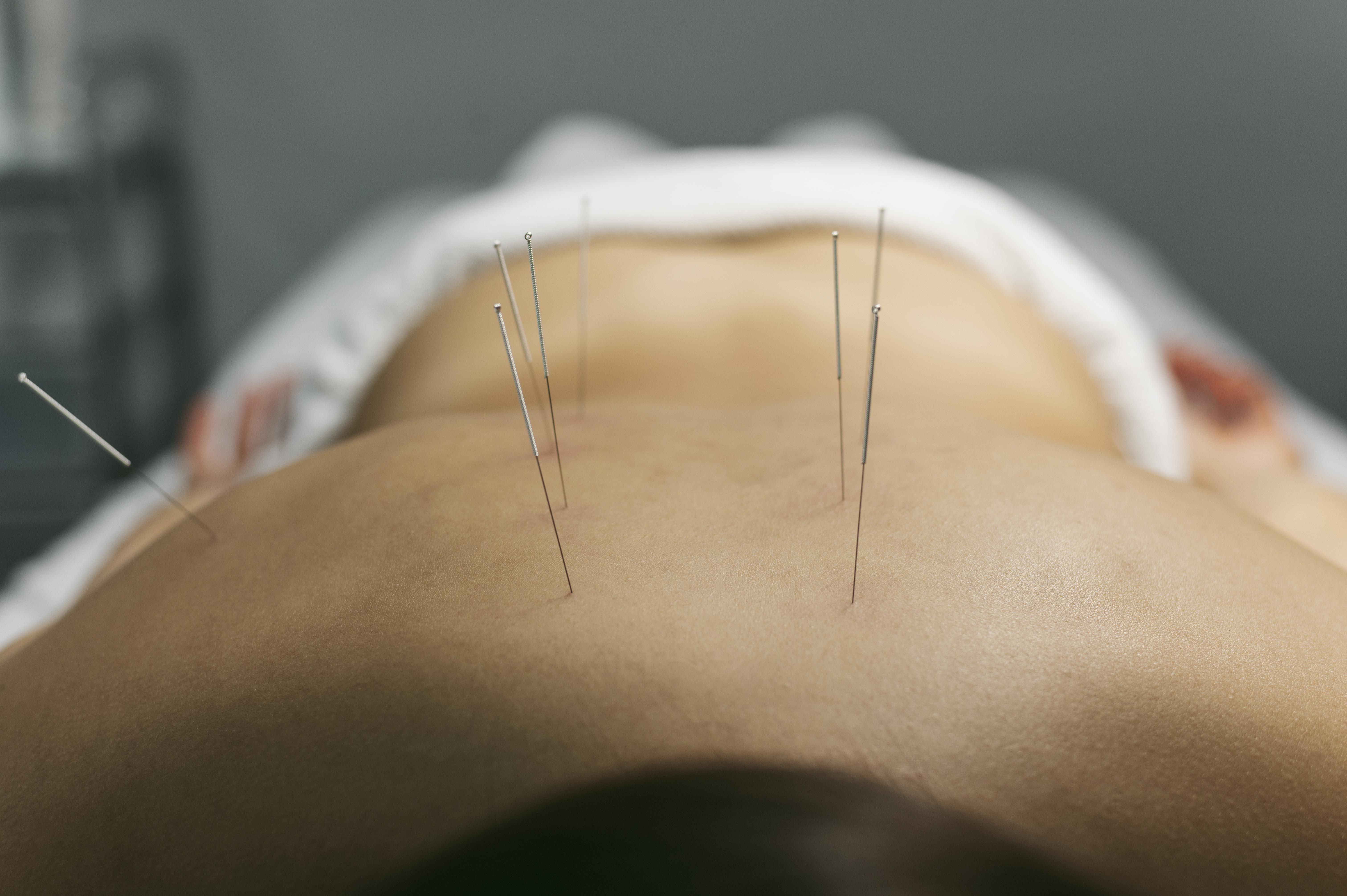 Acupuncture patient returning for follow-up session