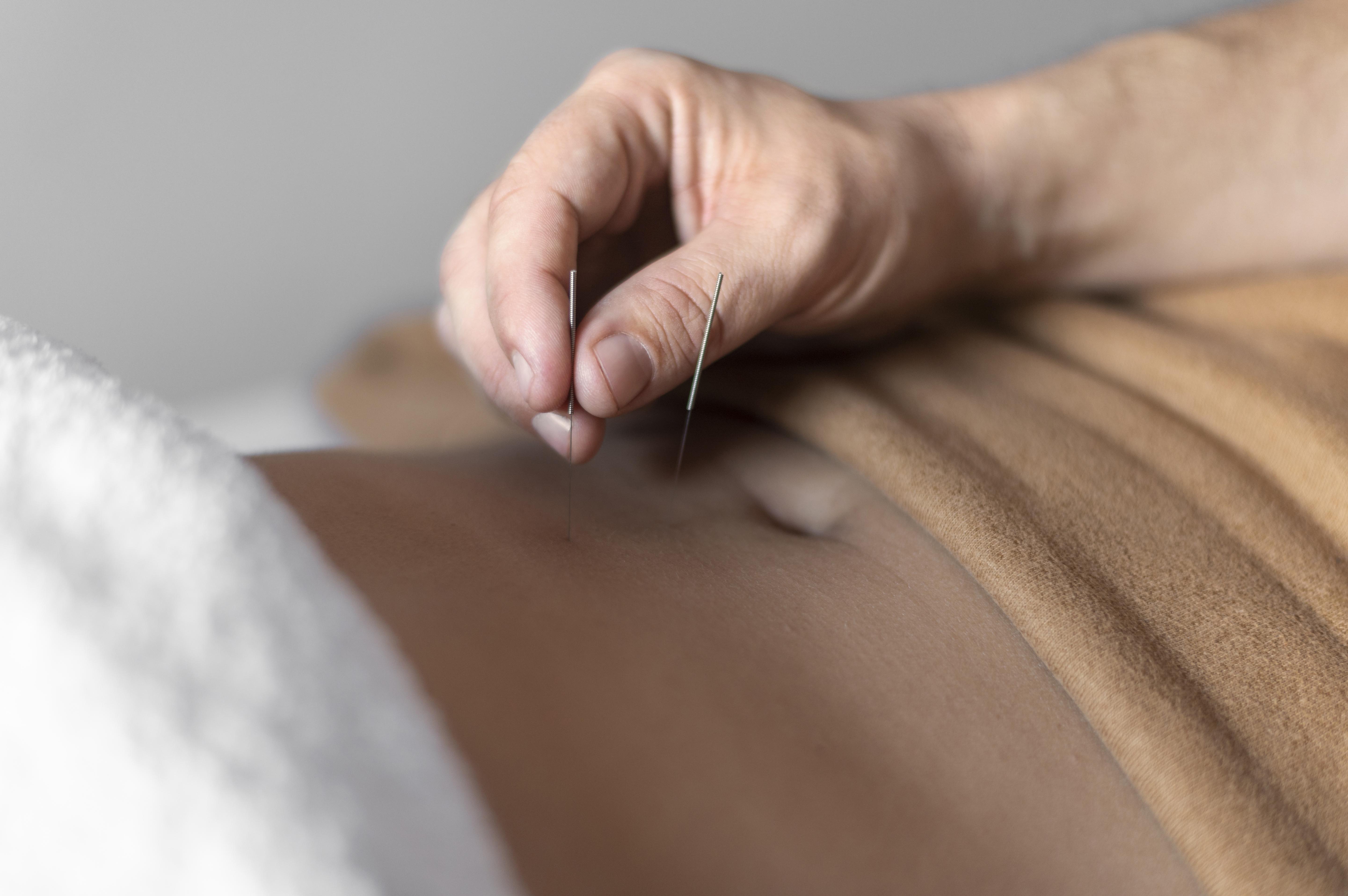 Acupuncturist networking with local wellness providers